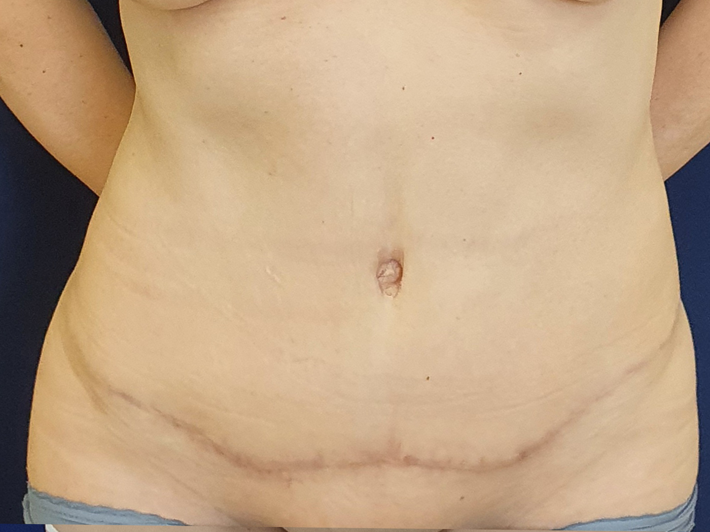 Vaginoplastie